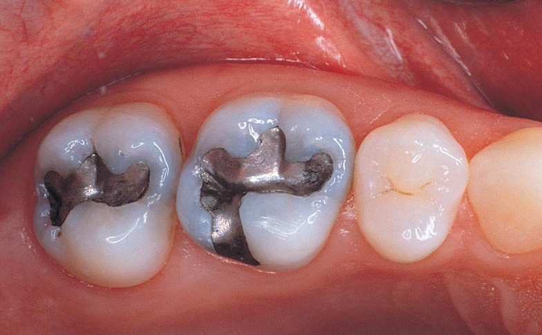 الحشو المعدني للأسنان