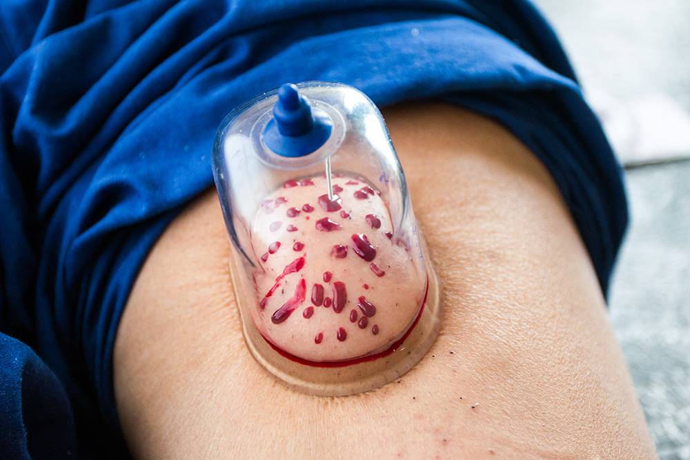 فوائد الحجامة الصحية