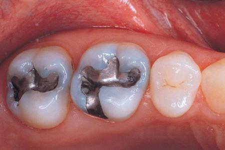 الحشو المعدني للأسنان